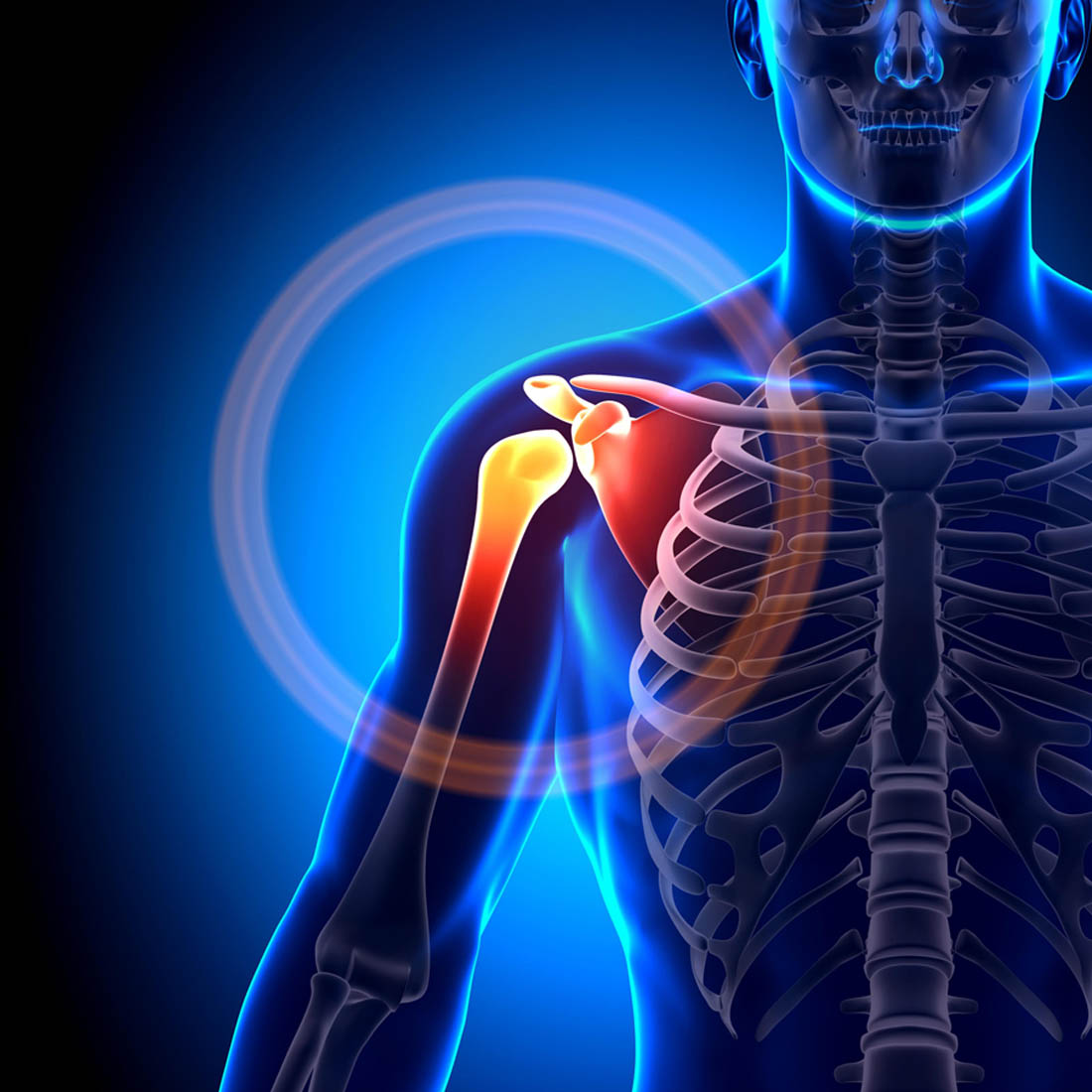 Rotator Cuff Injuries -  Identifying the Pain Caused by a Rotator Cuff  Injury
