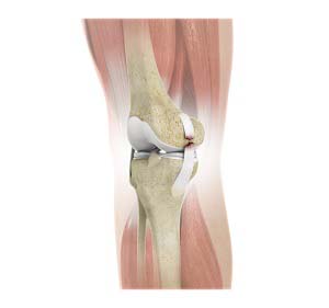 What are Medial Collateral Ligament (MCL) Tears & How to Recover